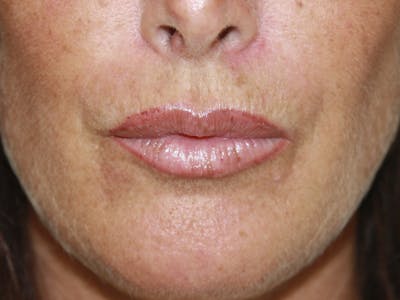 Juvederm Before & After Gallery - Patient 143521835 - Image 2
