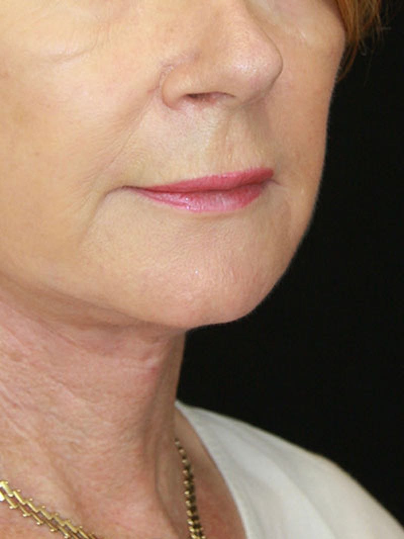 Facelift & Neck Lift Before & After Gallery - Patient 143521841 - Image 4