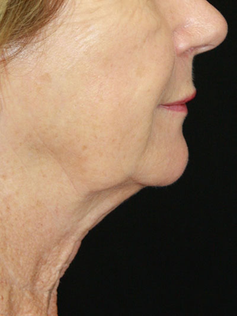 Facelift & Neck Lift Before & After Gallery - Patient 143521841 - Image 5