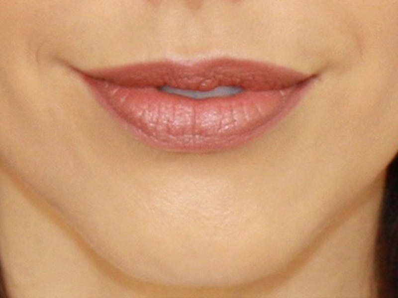 Lip Augmentation Before & After Gallery - Patient 143521836 - Image 1