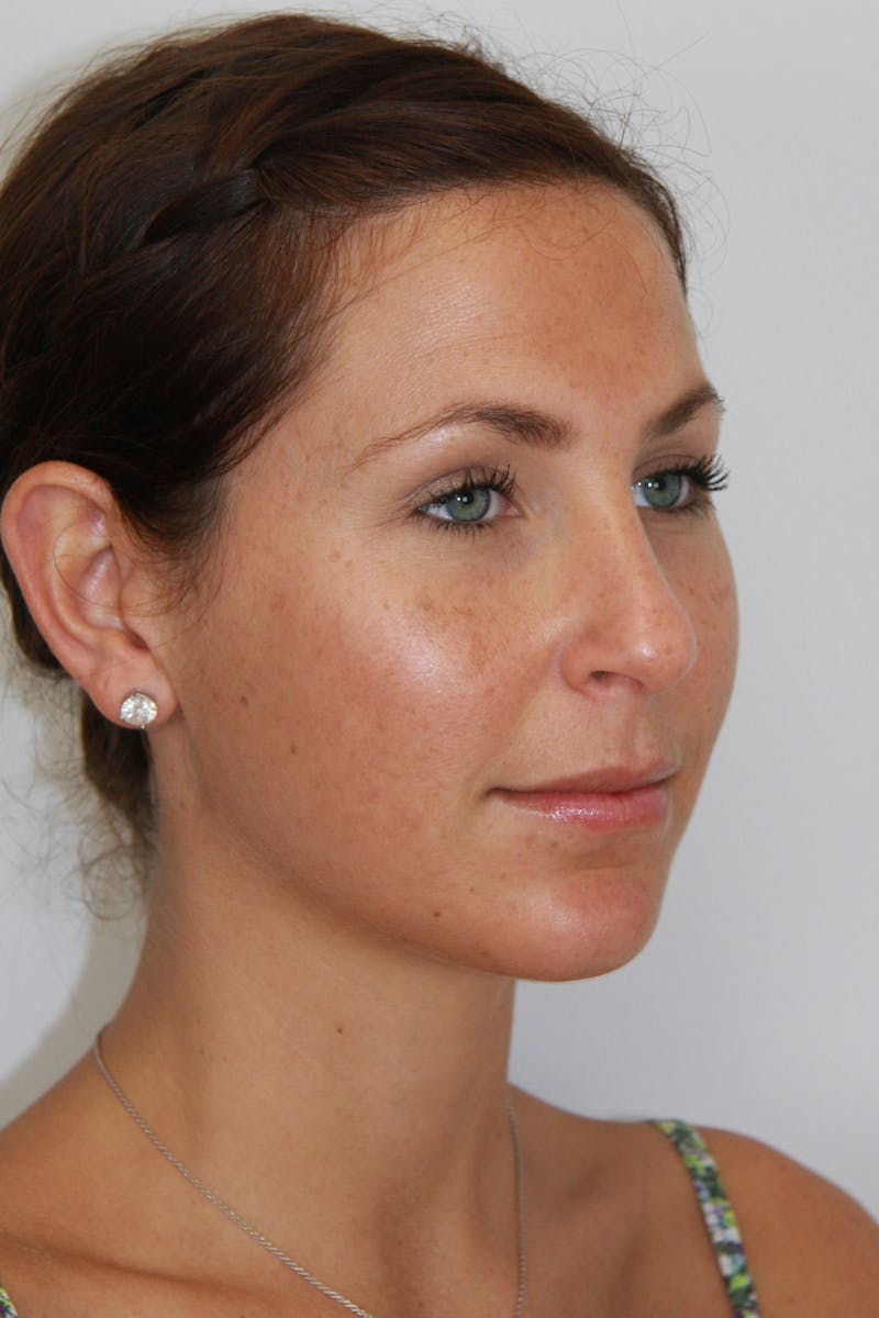 Chin Augmentation Before & After Gallery - Patient 143521843 - Image 4