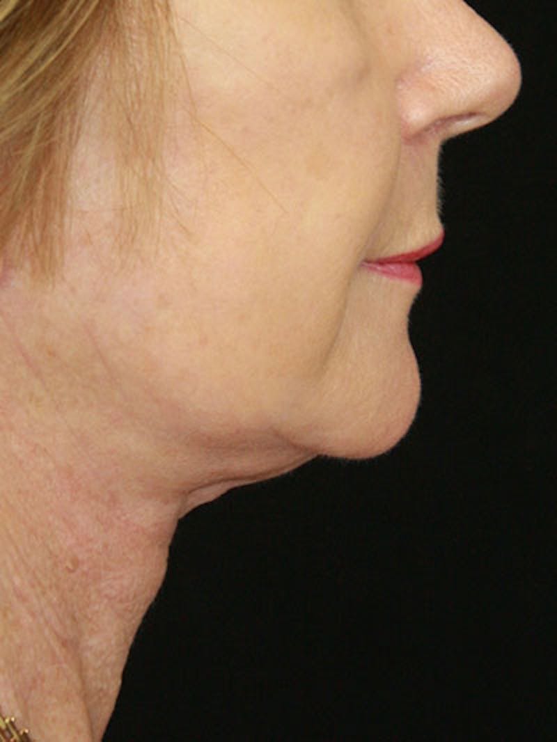 Facelift & Neck Lift Before & After Gallery - Patient 143521841 - Image 6