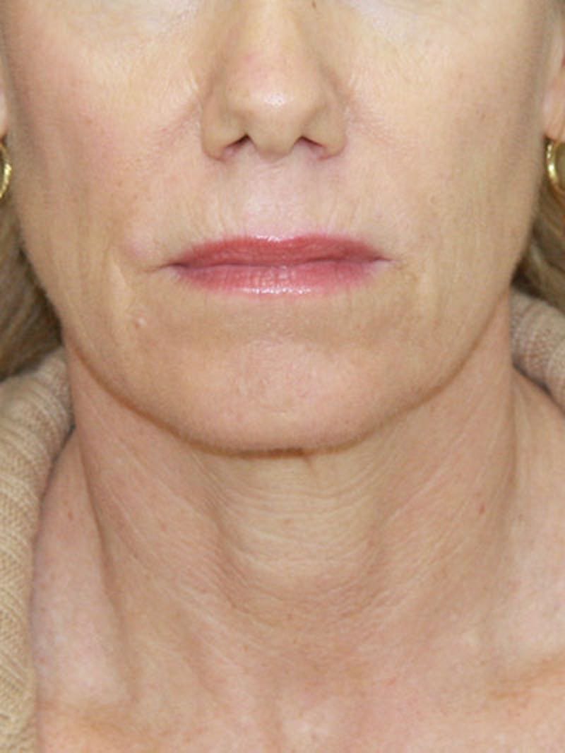 Facelift & Neck Lift Before & After Gallery - Patient 177544231 - Image 1