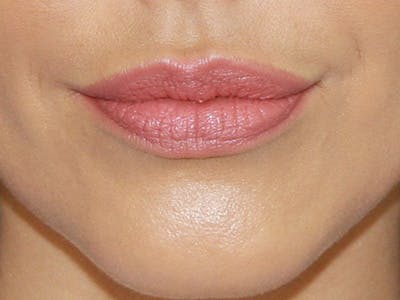 Lip Augmentation Before & After Gallery - Patient 143521836 - Image 2
