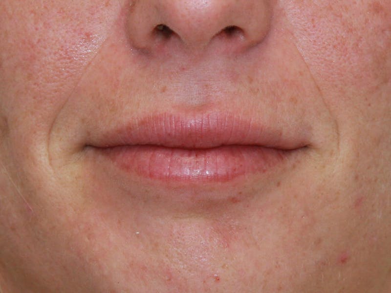 Juvederm Before & After Gallery - Patient 143521840 - Image 1
