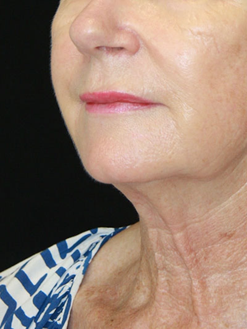 Facelift & Neck Lift Before & After Gallery - Patient 143521841 - Image 7