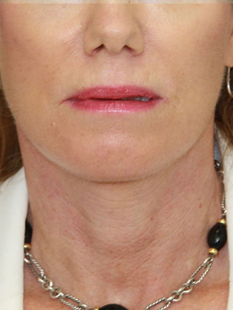 Facelift & Neck Lift Before & After Gallery - Patient 177544231 - Image 2