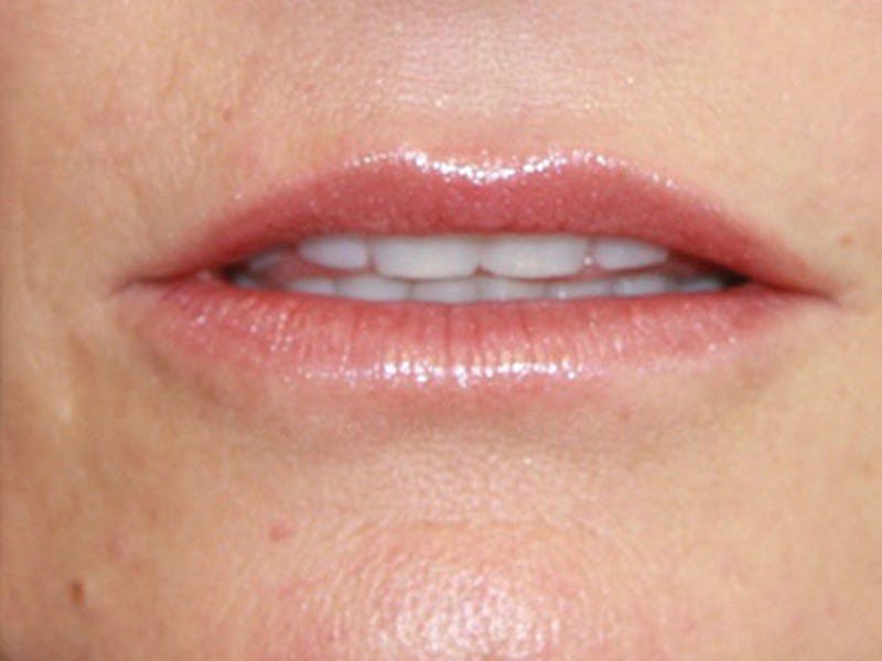 Lip Augmentation Before & After Gallery - Patient 143521838 - Image 1