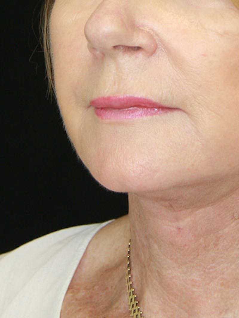Facelift & Neck Lift Before & After Gallery - Patient 143521841 - Image 8