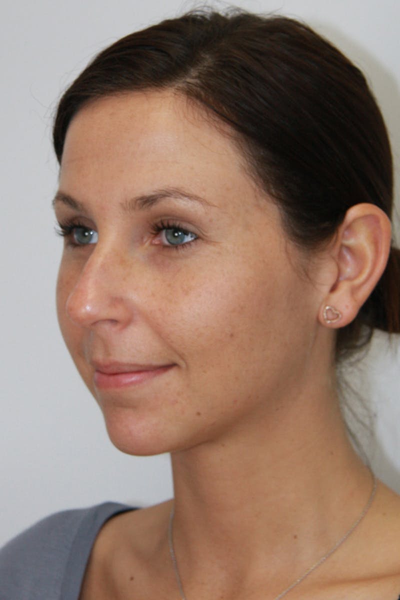 Chin Augmentation Before & After Gallery - Patient 143521843 - Image 5