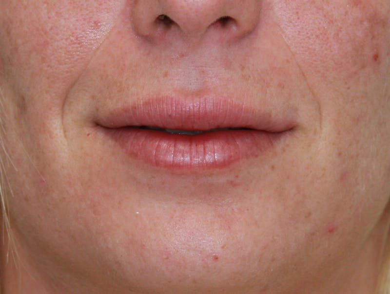 Juvederm Before & After Gallery - Patient 143521840 - Image 2