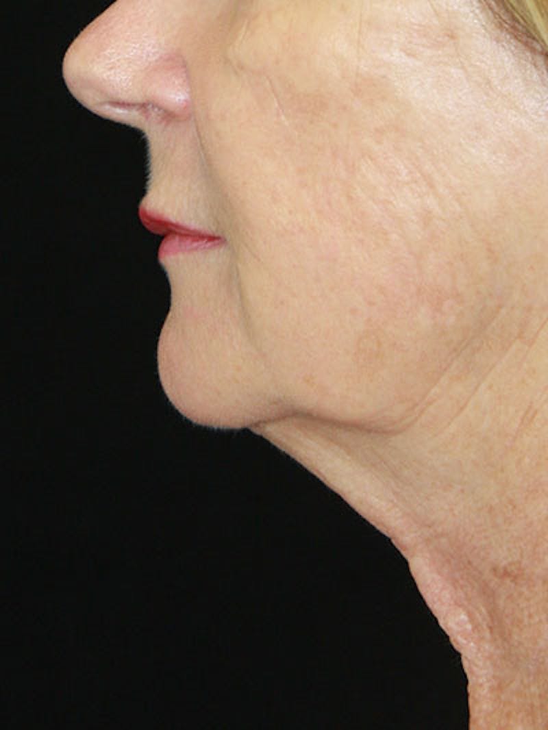 Facelift & Neck Lift Before & After Gallery - Patient 143521841 - Image 9