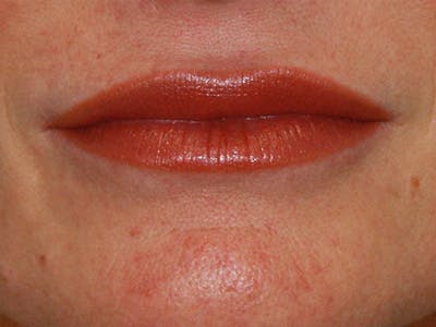 Lip Augmentation Before & After Gallery - Patient 143521838 - Image 2