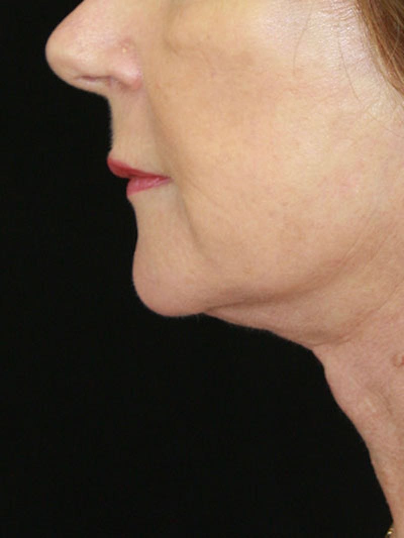 Facelift & Neck Lift Before & After Gallery - Patient 143521841 - Image 10