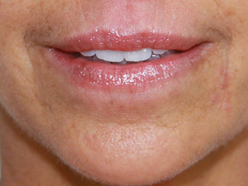 Lip Augmentation Before & After Gallery - Patient 143521842 - Image 1
