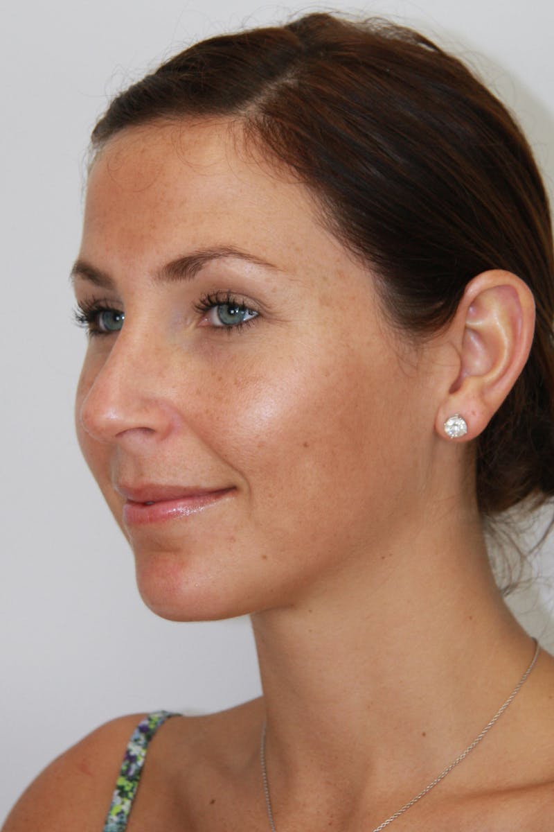 Chin Augmentation Before & After Gallery - Patient 143521843 - Image 6