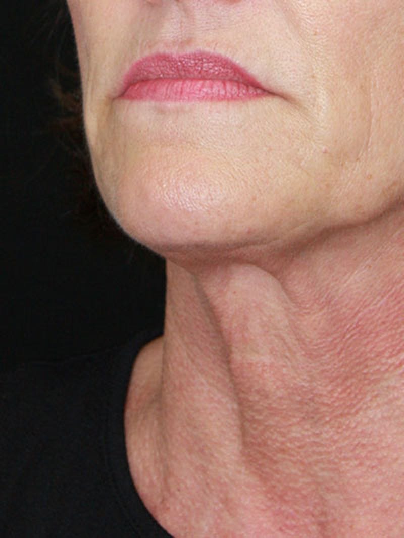 Facelift & Neck Lift Before & After Gallery - Patient 177544232 - Image 3