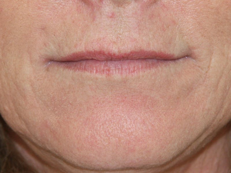 Juvederm Before & After Gallery - Patient 143521845 - Image 1