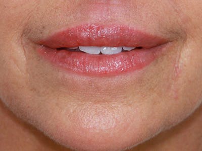 Lip Augmentation Before & After Gallery - Patient 143521842 - Image 2