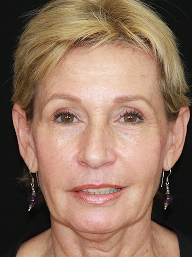 Facelift & Neck Lift Before & After Gallery - Patient 143521851 - Image 1