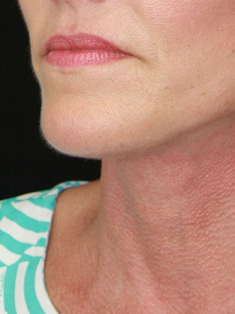 Facelift & Neck Lift Before & After Gallery - Patient 177544232 - Image 4