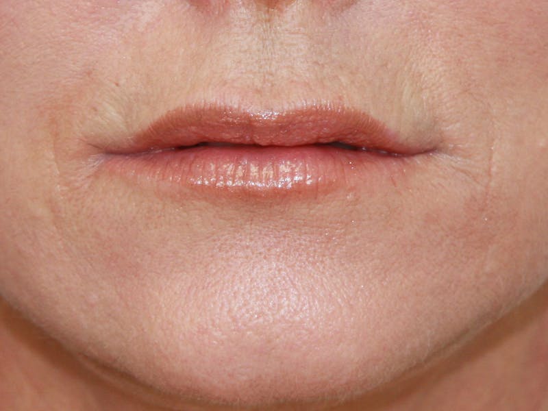 Juvederm Before & After Gallery - Patient 143521845 - Image 2