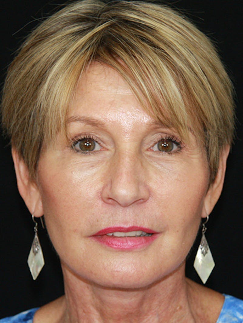 Facelift & Neck Lift Before & After Gallery - Patient 143521851 - Image 2