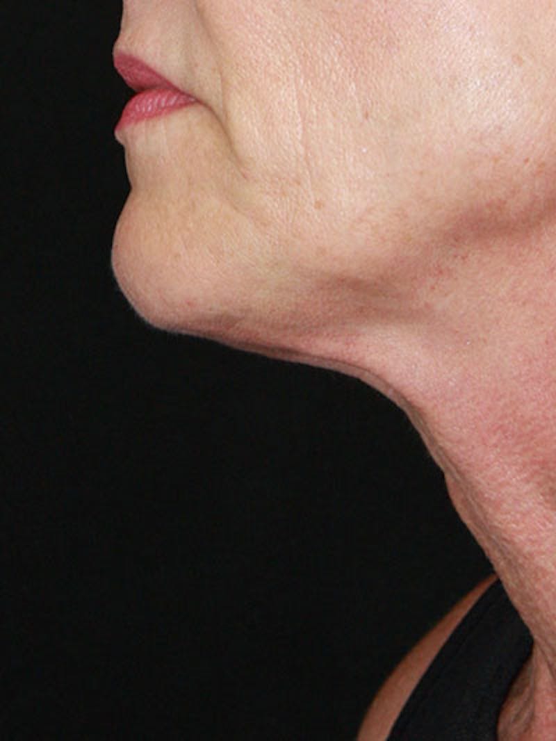 Facelift & Neck Lift Before & After Gallery - Patient 177544232 - Image 5