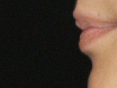 Lip Augmentation Before & After Gallery - Patient 143521846 - Image 1