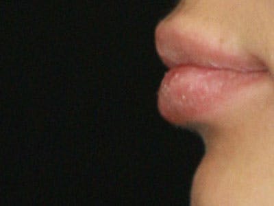 Lip Augmentation Before & After Gallery - Patient 143521846 - Image 2