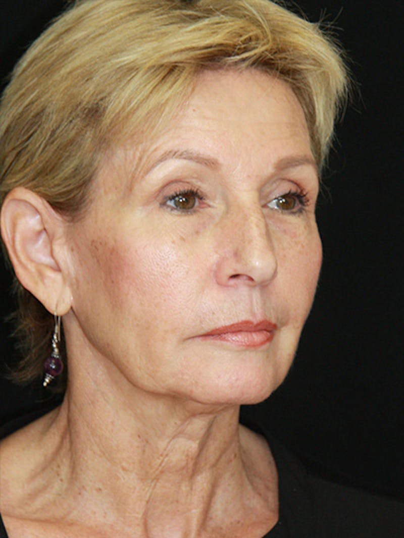 Facelift & Neck Lift Before & After Gallery - Patient 143521851 - Image 3