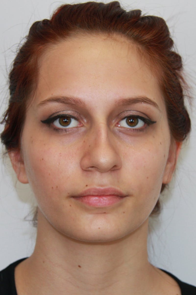 Chin Augmentation Before & After Gallery - Patient 143521865 - Image 1