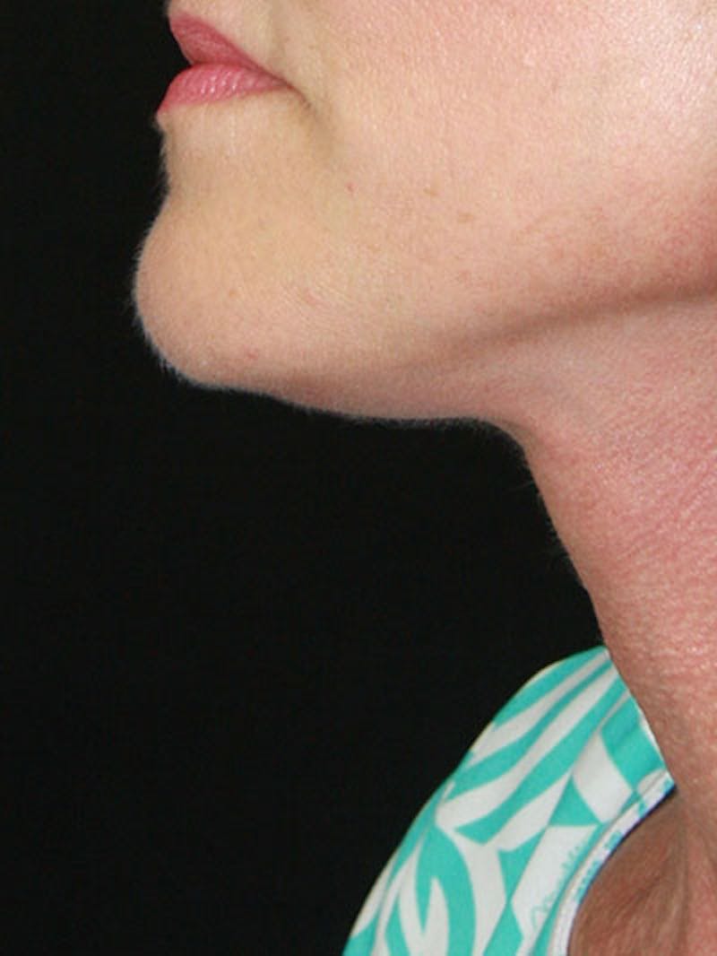 Facelift & Neck Lift Before & After Gallery - Patient 177544232 - Image 6