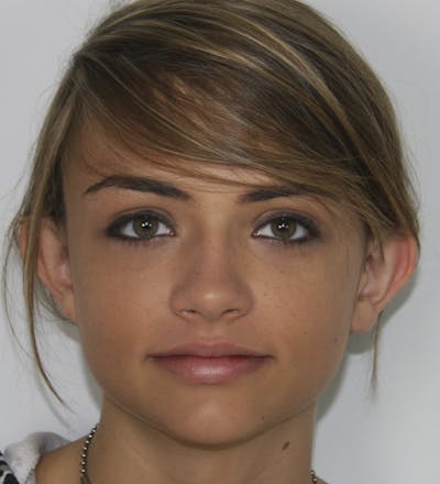 Otoplasty Before & After Gallery - Patient 143521848 - Image 1