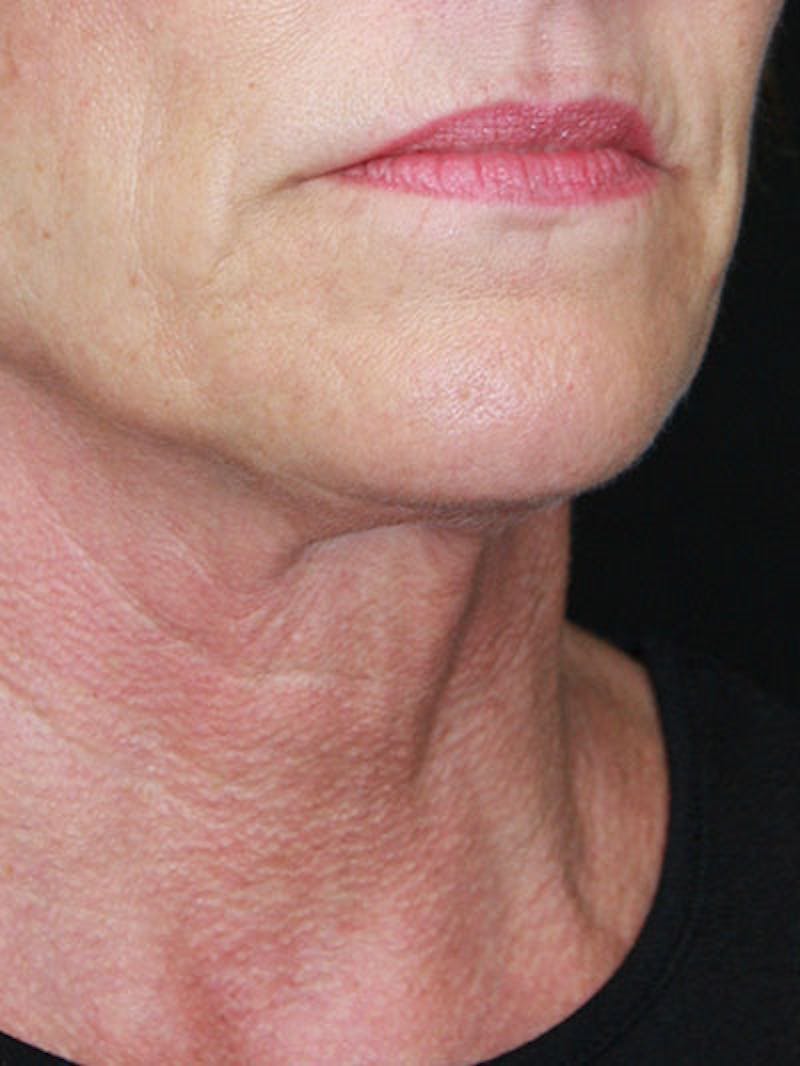 Facelift & Neck Lift Before & After Gallery - Patient 177544232 - Image 7