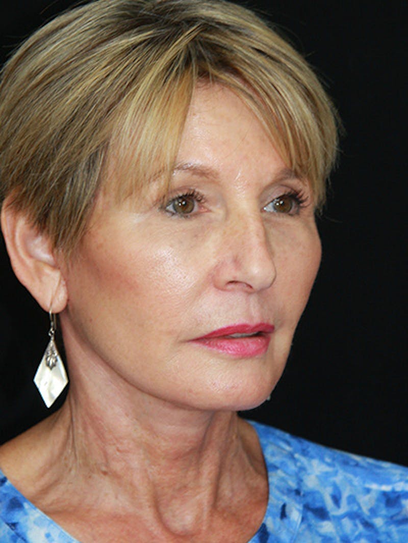 Facelift & Neck Lift Before & After Gallery - Patient 143521851 - Image 4