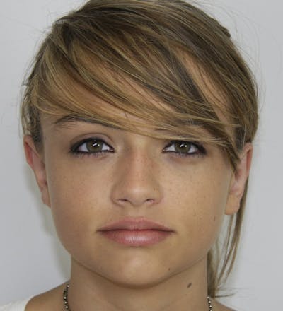 Otoplasty Before & After Gallery - Patient 143521848 - Image 2