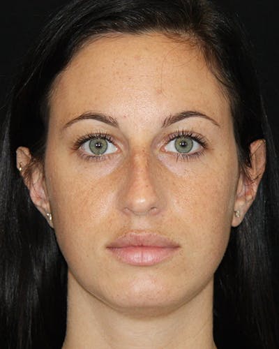 Rhinoplasty Before & After Gallery - Patient 143521854 - Image 1