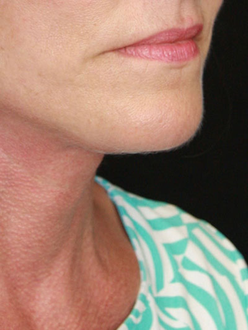 Facelift & Neck Lift Before & After Gallery - Patient 177544232 - Image 8