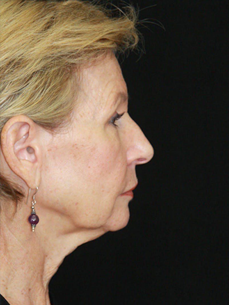 Facelift & Neck Lift Before & After Gallery - Patient 143521851 - Image 5