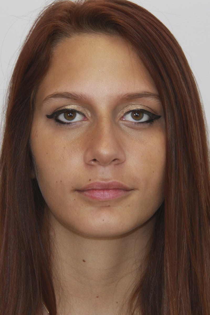 Chin Augmentation Before & After Gallery - Patient 143521865 - Image 2