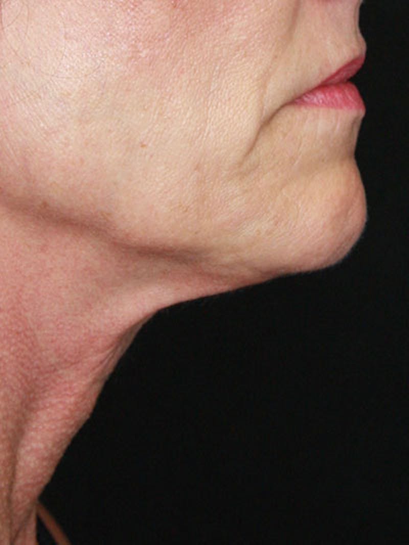 Facelift & Neck Lift Before & After Gallery - Patient 177544232 - Image 9