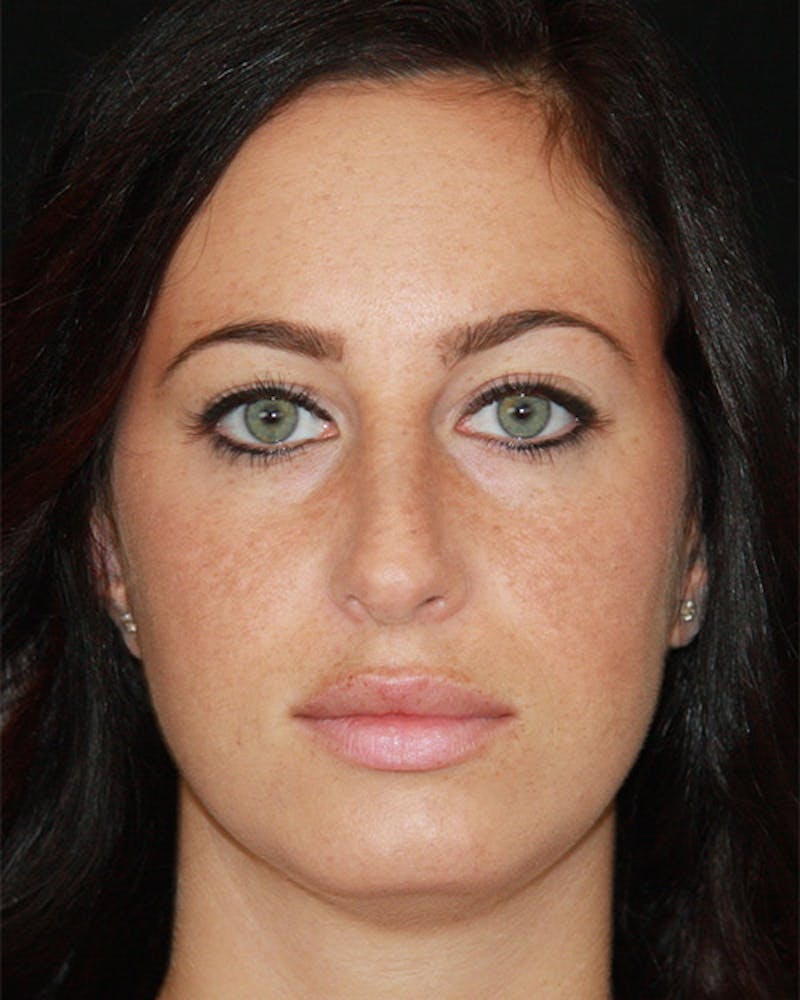 Rhinoplasty Before & After Gallery - Patient 143521854 - Image 2