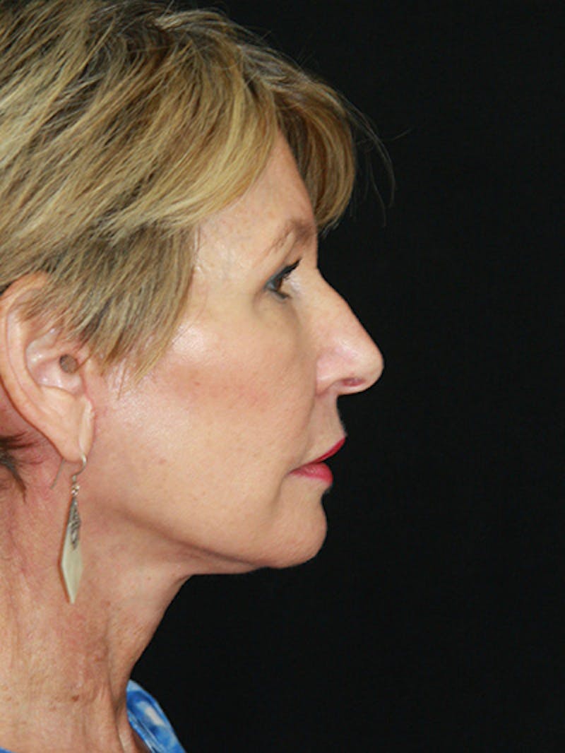 Facelift & Neck Lift Before & After Gallery - Patient 143521851 - Image 6