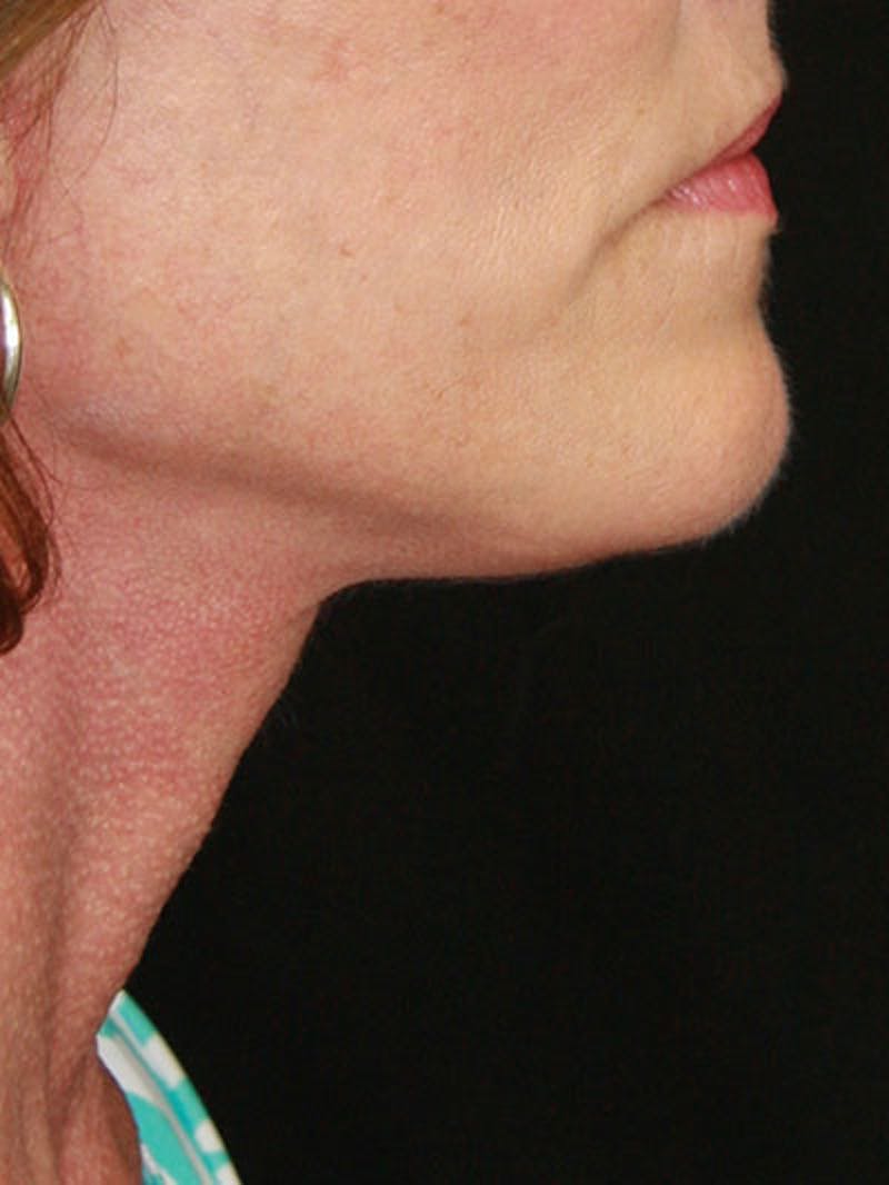 Facelift & Neck Lift Before & After Gallery - Patient 177544232 - Image 10
