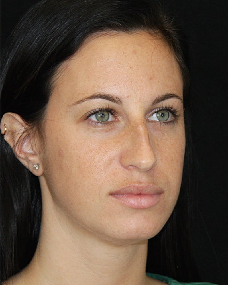 Rhinoplasty Before & After Gallery - Patient 143521854 - Image 3