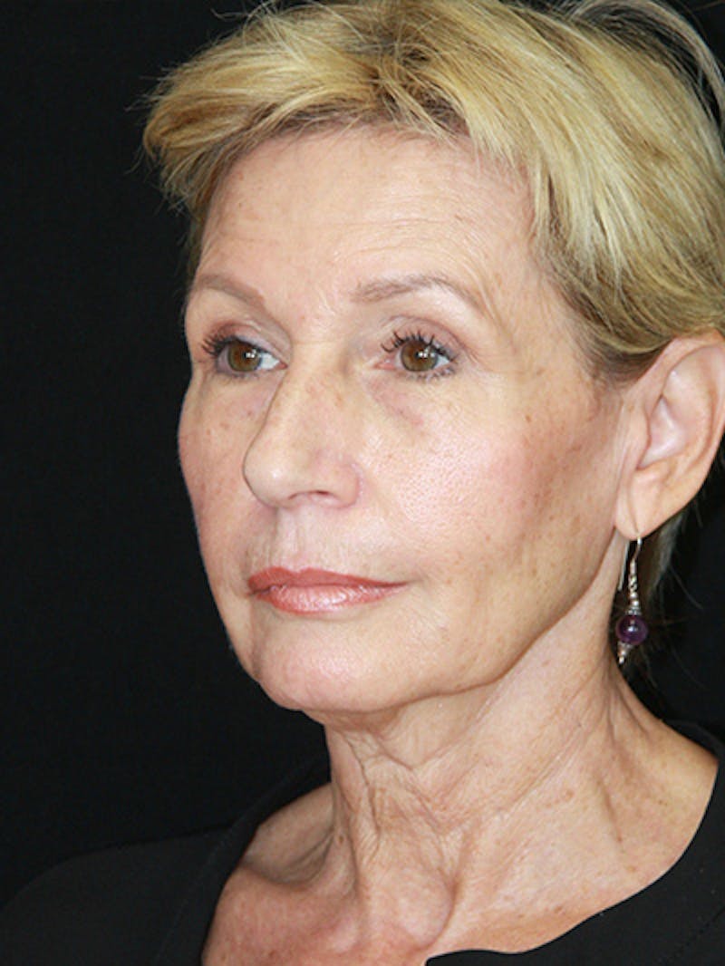 Facelift & Neck Lift Before & After Gallery - Patient 143521851 - Image 7