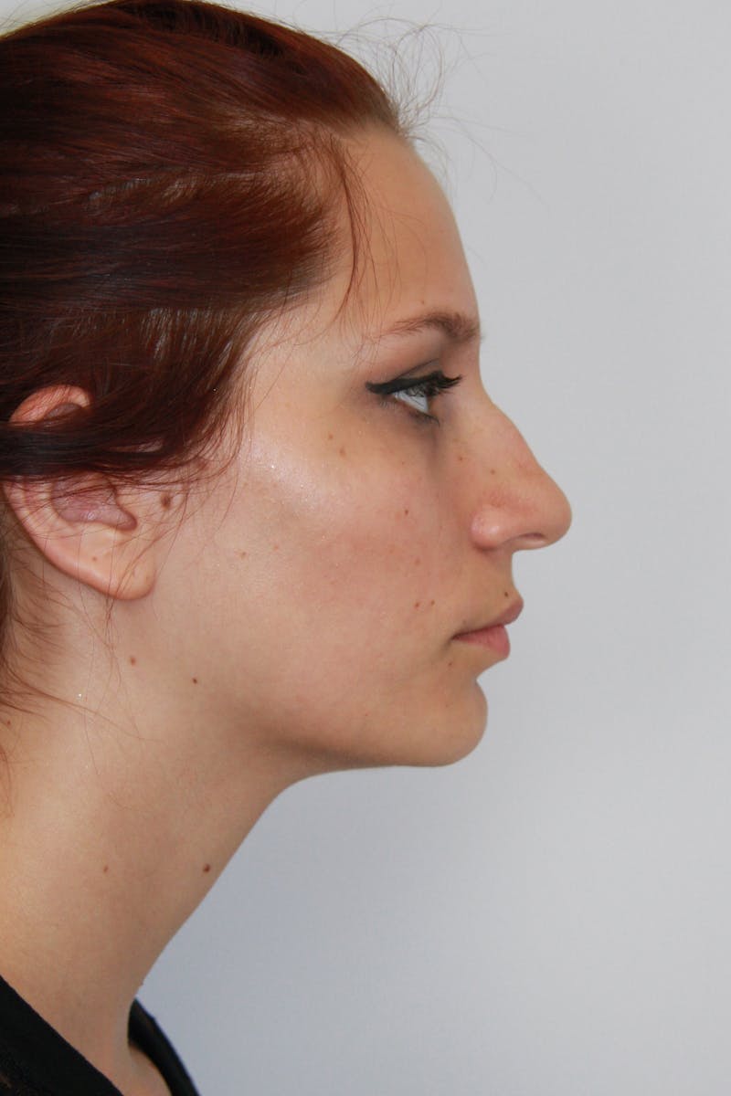 Chin Augmentation Before & After Gallery - Patient 143521865 - Image 3