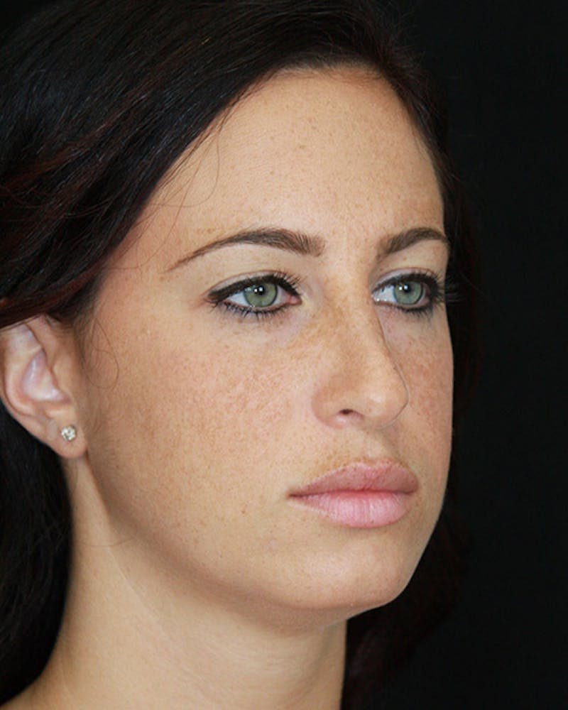 Rhinoplasty Before & After Gallery - Patient 143521854 - Image 4