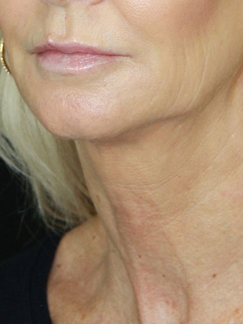 Facelift & Neck Lift Before & After Gallery - Patient 177546574 - Image 1